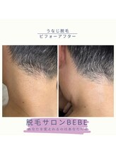 ベベ(Bebe)/うなじ脱毛