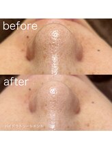 ルルラ リコ(lulula rico)/症例写真/ハイドラ毛穴洗浄