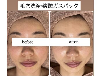 タイズレリーフ(TIES RELIEF)/