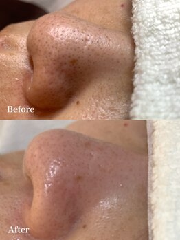 ウエカ(ueka)/30代後半 黒ずみ毛穴を改善