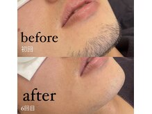 さつき整骨院/デザイン脱毛