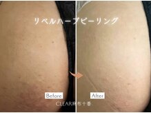 クリア 麻布十番(CLEAR)/リベルハーブピーリング　剥離