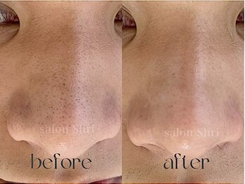 シュリ(Shri)/毛穴黒ずみ・角栓・凹凸