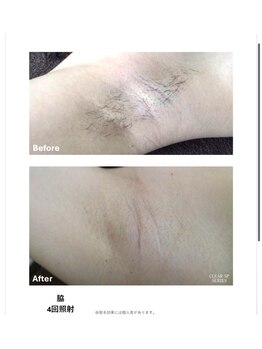 リネ(Rine)/【before→after】