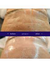 ティア(TIA)/superjection