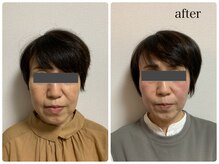 ナチュライズ(NatuRise)の雰囲気（小顔・リフトアップ・毛穴・肌のハリ・ツヤに美容鍼）