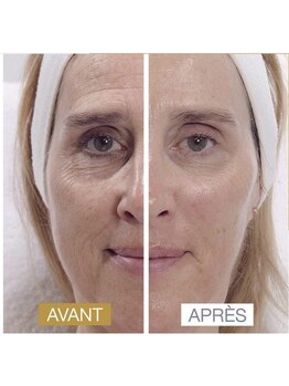 ティーボックスボーテ(TBOX beaute)/たるみ改善フェイシャルエステ