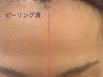 ポマイカイ 名古屋丸の内店(pomaikai)/ハイドロフェイシャル