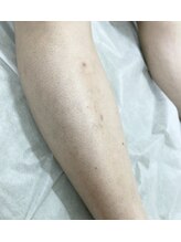 ナノハナ/鹿沼市の全身脱毛美容室ナノハナ