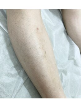 ナノハナ/鹿沼市の全身脱毛美容室ナノハナ