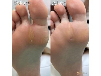 巻き爪補正店 北千住店/施術【たこ・魚の目ケア】