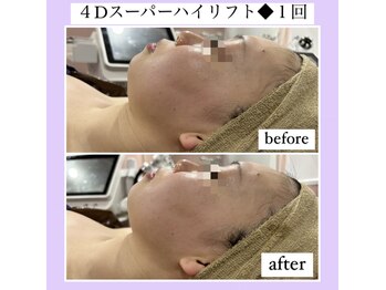 ルピナス ヒサヤ(LUPINUS hisaya)/小顔４Dスーパーハイリフト