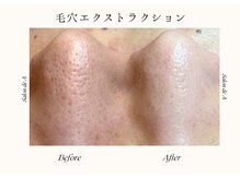 サロンドエー 帝塚山(Salon de A)/鼻に毛穴なんて要らない！！！