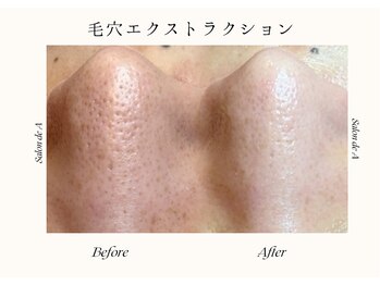 サロンドエー 帝塚山(Salon de A)/鼻に毛穴なんて要らない!!!