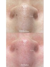 クレヴィー(Creviy)/韓国式3D毛穴洗浄(初回1回目)