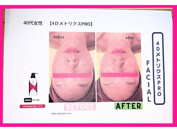 フレクシー/４D　beforeafter