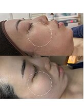 オーシャンブルーム 目黒(OceanBloom)/毛穴/くすみ