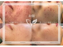 ハーバリー ハーブピーリング 栄(HERBERRYハーブピーリング)の雰囲気（毛穴ケア/ニキビ/シミ改善にはハーブピーリングが最強♪）