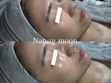 ナチュールムーン(Nature moon.)/ハーブピーリング
