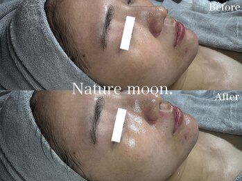 ナチュールムーン(Nature moon.)/ハーブピーリング