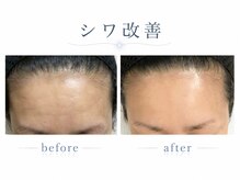 シャルナ(charna)の雰囲気（シワ改善症例）
