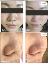 ロージィーローズ(Rosy Rose)/ハイドロフェイシャルの毛穴洗浄