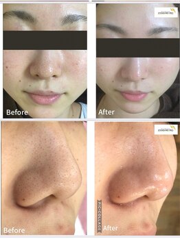 ロージィーローズ(Rosy Rose)/ハイドロフェイシャルの毛穴洗浄