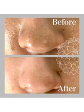 ダリア(DAHLIA)/ハイドラスプラッシュ／毛穴洗浄