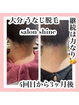 サロンシャイン(Salon Shine)/うなじ脱毛経過４回目