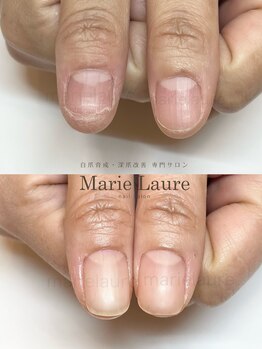 マリーロール 梅田店(Marie Laure)/深爪矯正/自爪育成/ネイルケア