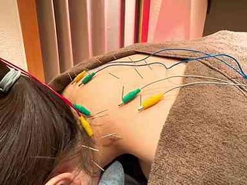 高田馬場はりきゅう院/肩のコリ・重さへの鍼灸