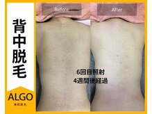 アルゴ 山口宇部店(ALGO)/美肌脱毛専門店