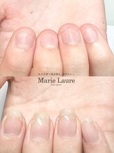 マリーロール 梅田店(Marie Laure)/自爪育成/深爪矯正/ネイルケア