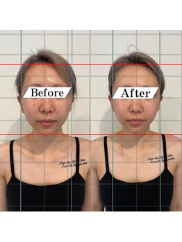 ドクターボディ 浜松店(Dr.Body)/【人中短縮/中顔面/横幅縮小】