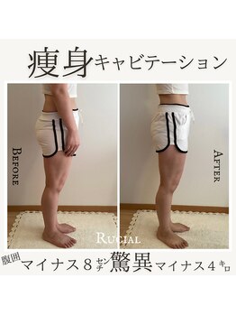 ルシアル(Rucial)/痩身キャビでサイズダウン♪♪