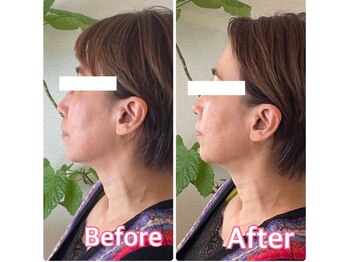 小顔矯正サロン ブルーム/1回の施術変化