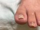 オンリーネイル(Only Nail)の写真/オシャレは足元から♪巻き爪・深爪の悩みから解放☆【片足軽度￥5500～】足爪補正士による施術で徹底ケア！