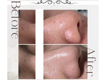 ピュアル 川口(Pual)/【毛穴/開き/つまり】Pual症例