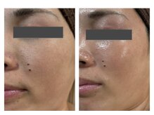 ザ ワン(THE ONE)/ヴェルナハーブピーリング