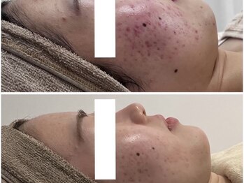 アンリミット 鹿児島天文館店(Une limit)/本気の肌質改善！