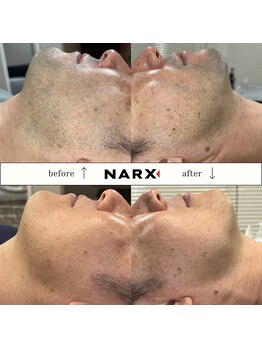 ナークス(NARX)/【ヒゲ脱毛】ビフォーアフター
