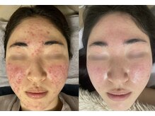 リリアス(RILLIAS)/ニキビケア