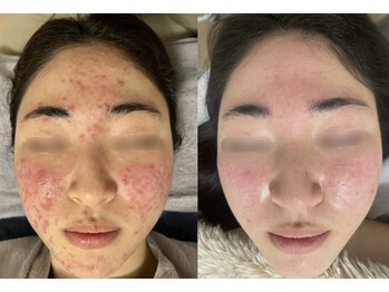 リリアス(RILLIAS)/ニキビケア