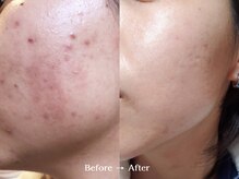 ヴィサージュ 下通店/皮脂・ニキビ集中ケア＋肌育