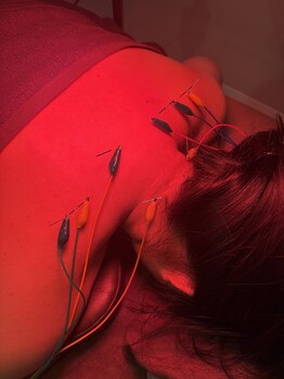 イリス 神田(iris)/首肩コリには鍼!!