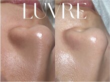 ルーヴレ(LUVRE)/毛穴洗浄