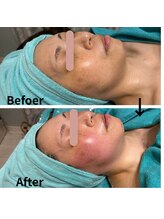 ラ ピュール(LA PUR)/リフトUPケア