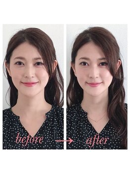 ラグラン銀座メディカルエステ 高輪ゲートウェイ店/ 小顔施術のお写真