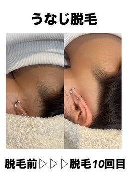 サロンエヌ 久留米店(Salon N)/女性のうなじ脱毛★