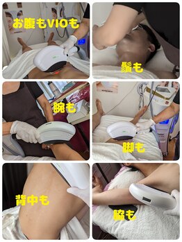 フレクシー/メンズ脱毛